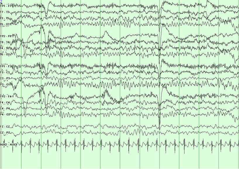 eeg seizure vs normal