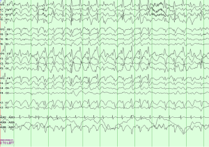 AS EEG